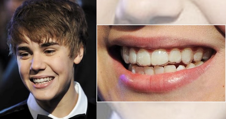 How To Get Straight Teeth Like Justin Bieber