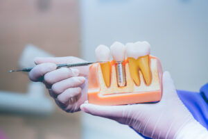 The Dentist Centrepoint Loves for Replacing Teeth With Implants